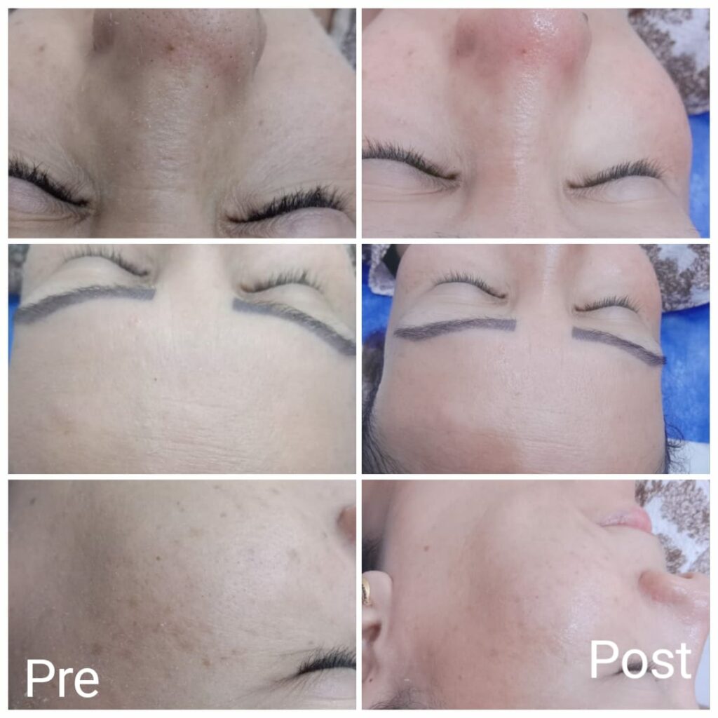 Results of laser skin cleansing sessions